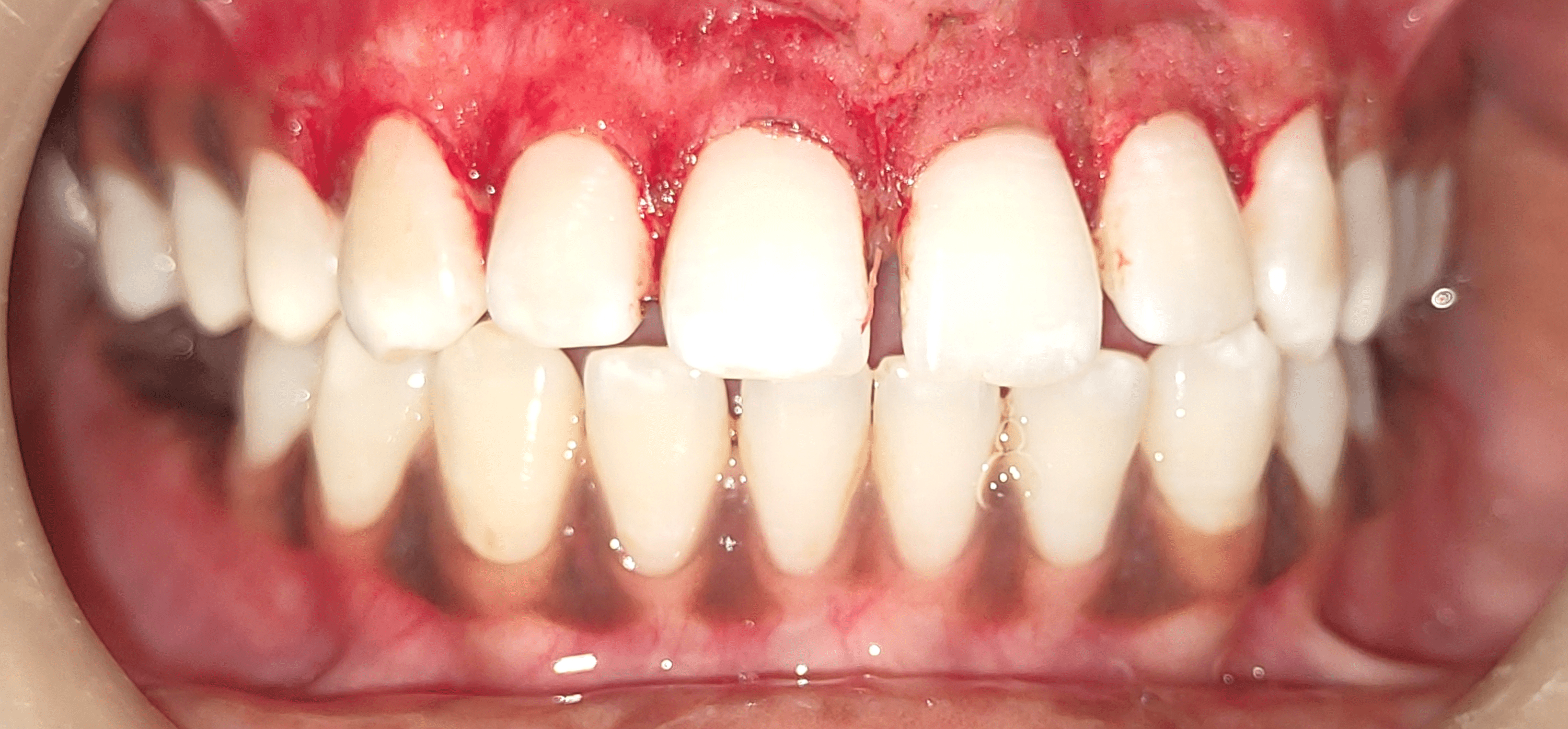 Cureus A Comparison Between the Efficacy of Scalpel and Laser