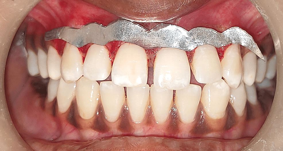 Cureus A Comparison Between the Efficacy of Scalpel and Laser