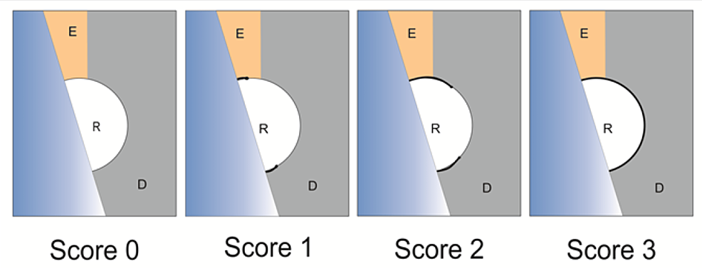 Scoring-system-to-measure-dye-penetration