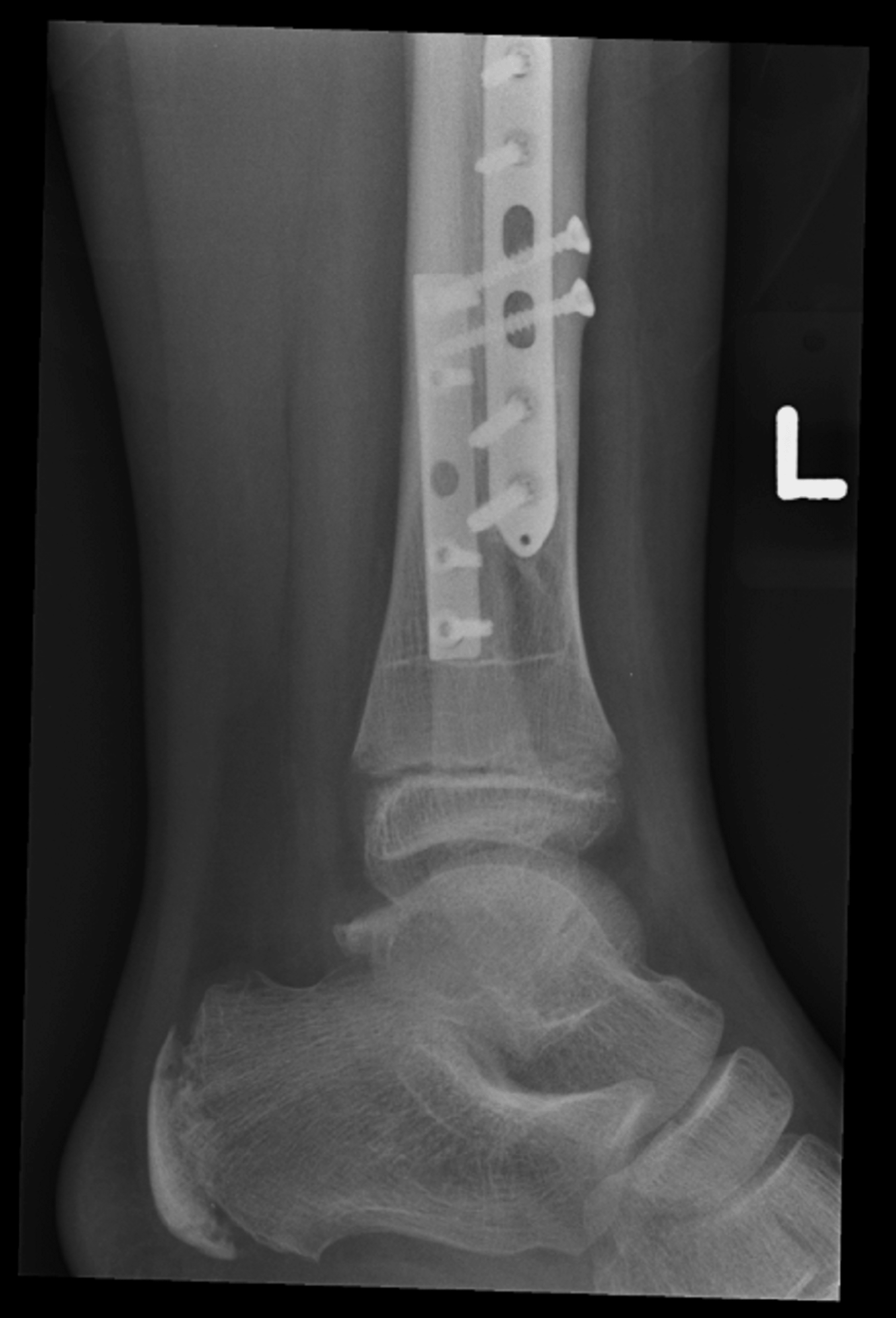 Pathological Distal Tibial and Fibular Fracture in a Paediatric Patient ...