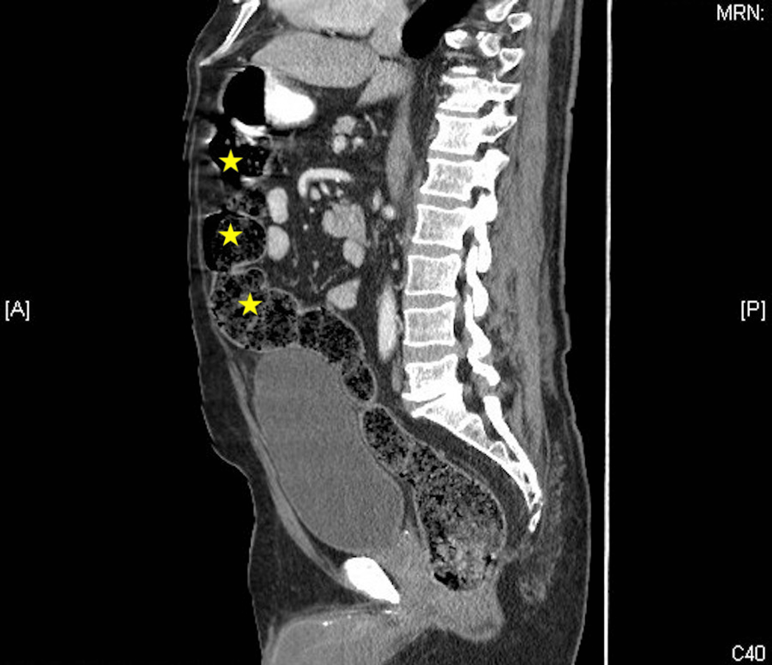 Cureus Cecal Diverticulitis in a Geriatric Patient
