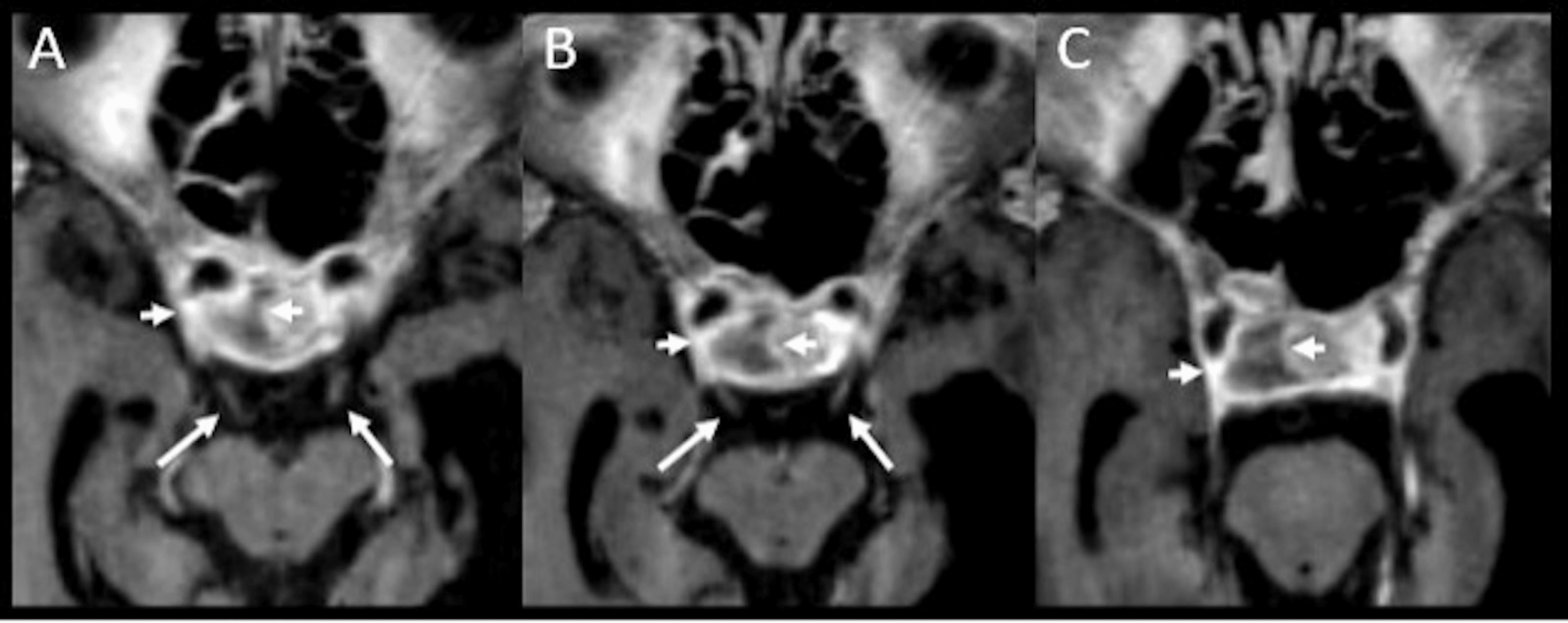 Pituitary Apoplexy (PA): Delayed Diagnosis Of A Rare Clinical Syndrome ...