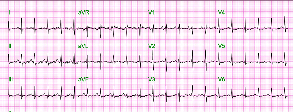 Admission-EKG-showing-sinus-tachycardia