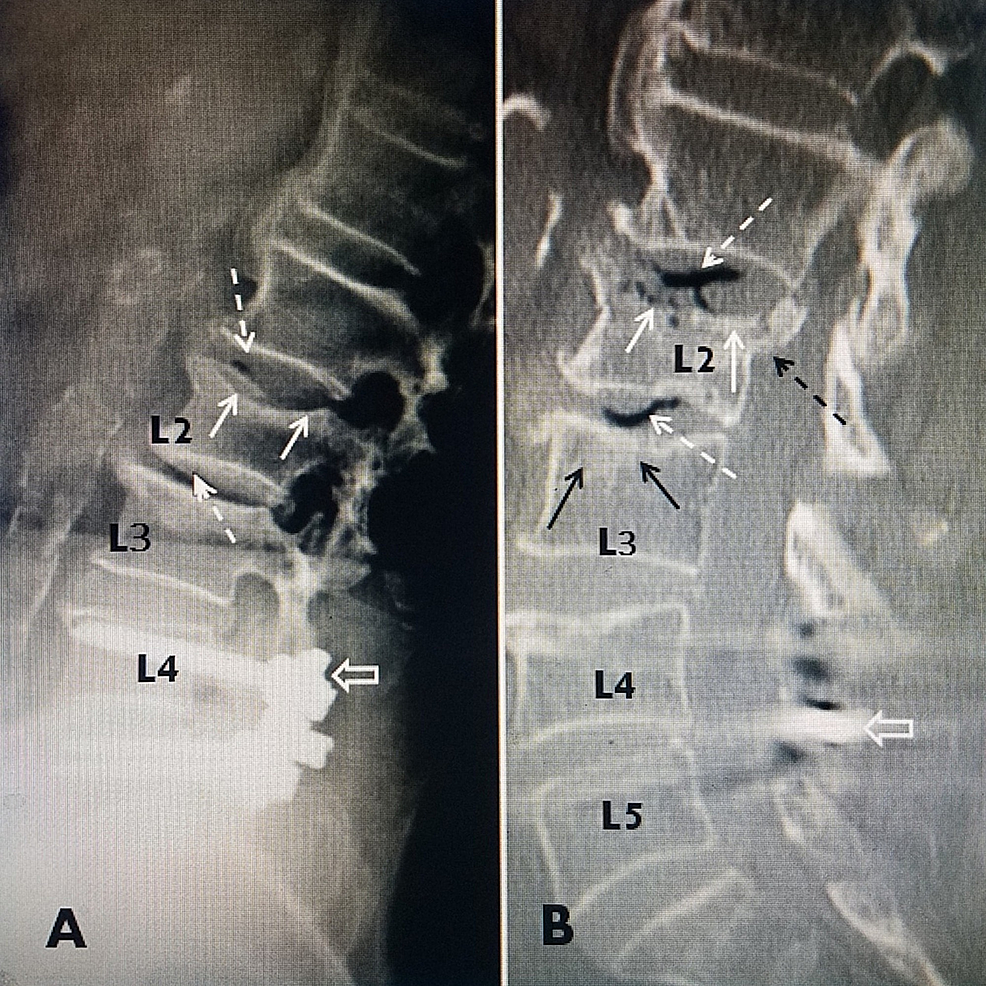 Acute and chronic vertebral compression fractures, Radiology Case