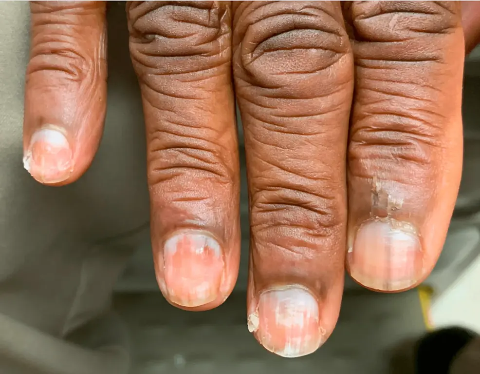 Cureus | Dystrophic Nails: An Unusual Clue to Recurrent Lymphoma | Article