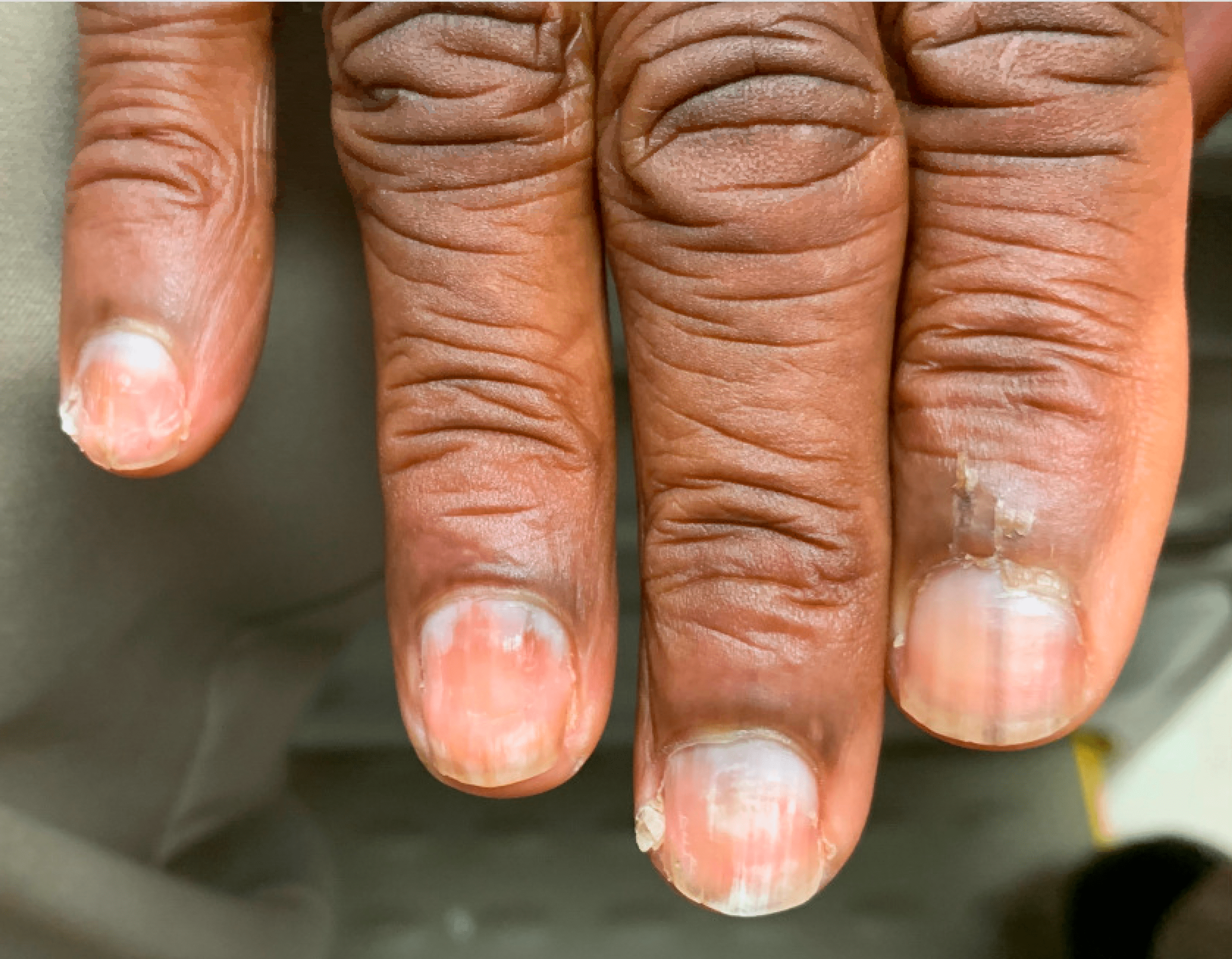 Cureus | Dystrophic Nails: An Unusual Clue to Recurrent Lymphoma