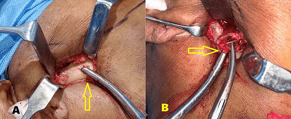 Intraoperative-images