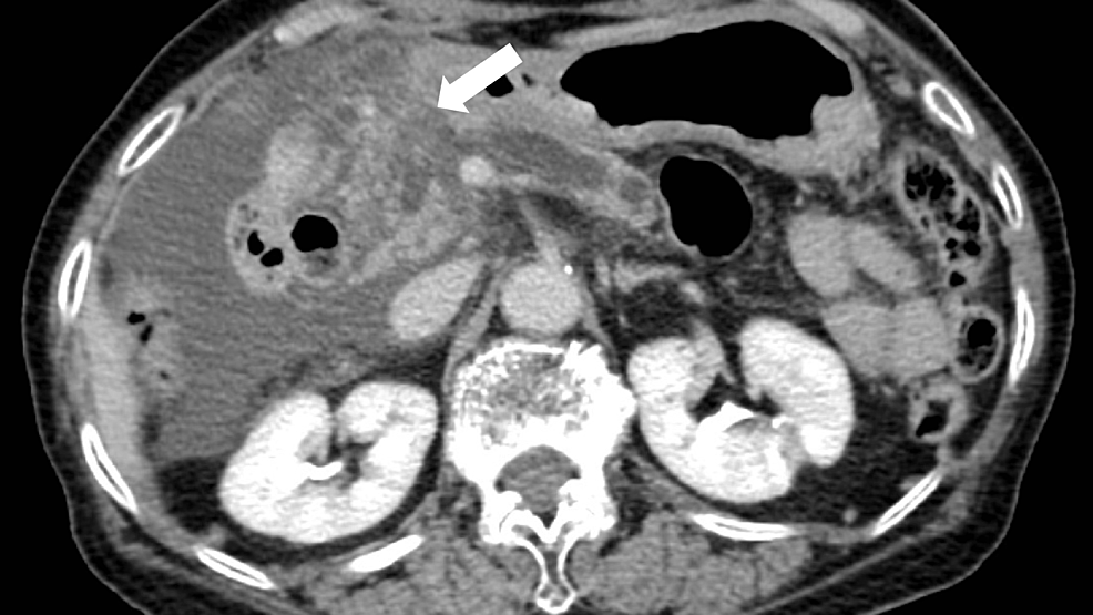 Contrast-enhanced-computed-tomography-image-of-the-abdominopelvic-region-showing-an-enlarged-pancreatic-head-(white-arrow)