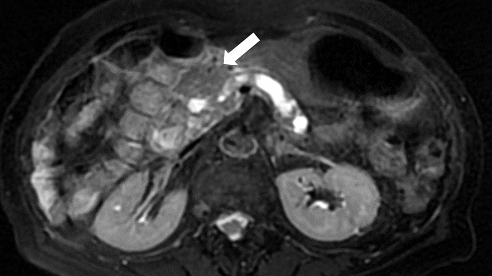 Magnetic-resonance-image-showing-a-decreasing-trend-of-findings-of-acute-pancreatitis-in-the-pancreatic-head-with-mild-swelling-in-the-pancreatic-head-(white-arrow)