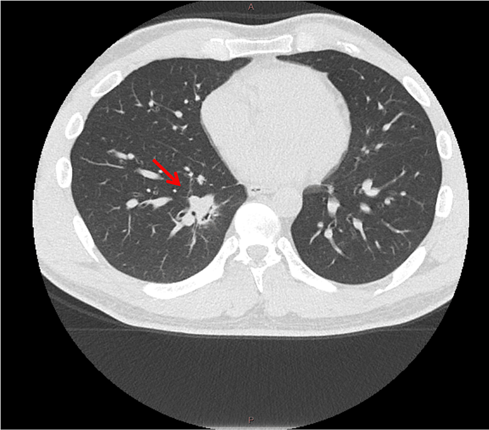 cureus-inflammatory-myofibroblastic-tumor-mimicking-a-cavitary-lesion