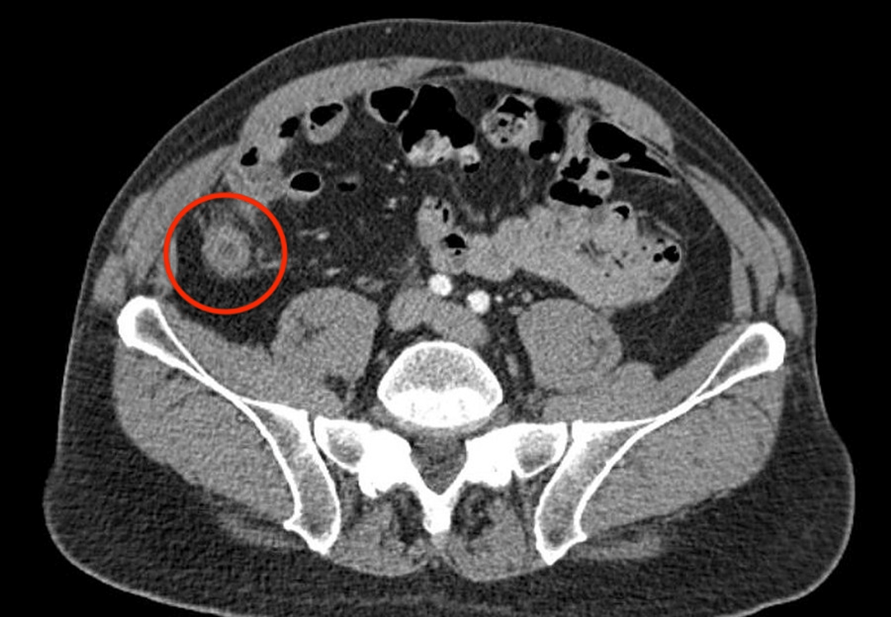 cureus-primary-appendiceal-adenocarcinoma-masquerading-as-acute