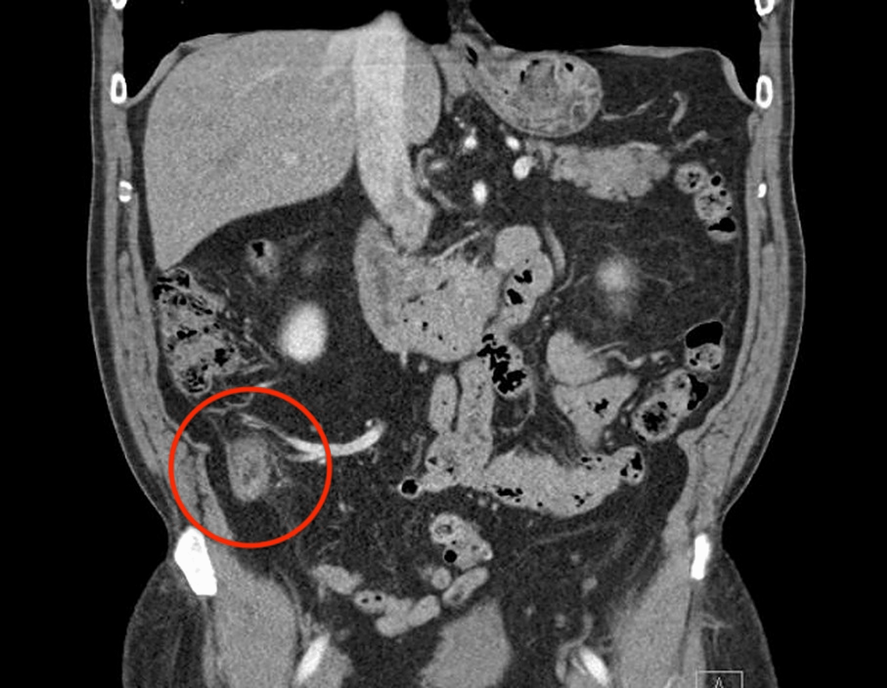 Cureus Primary Appendiceal Adenocarcinoma Masquerading as Acute