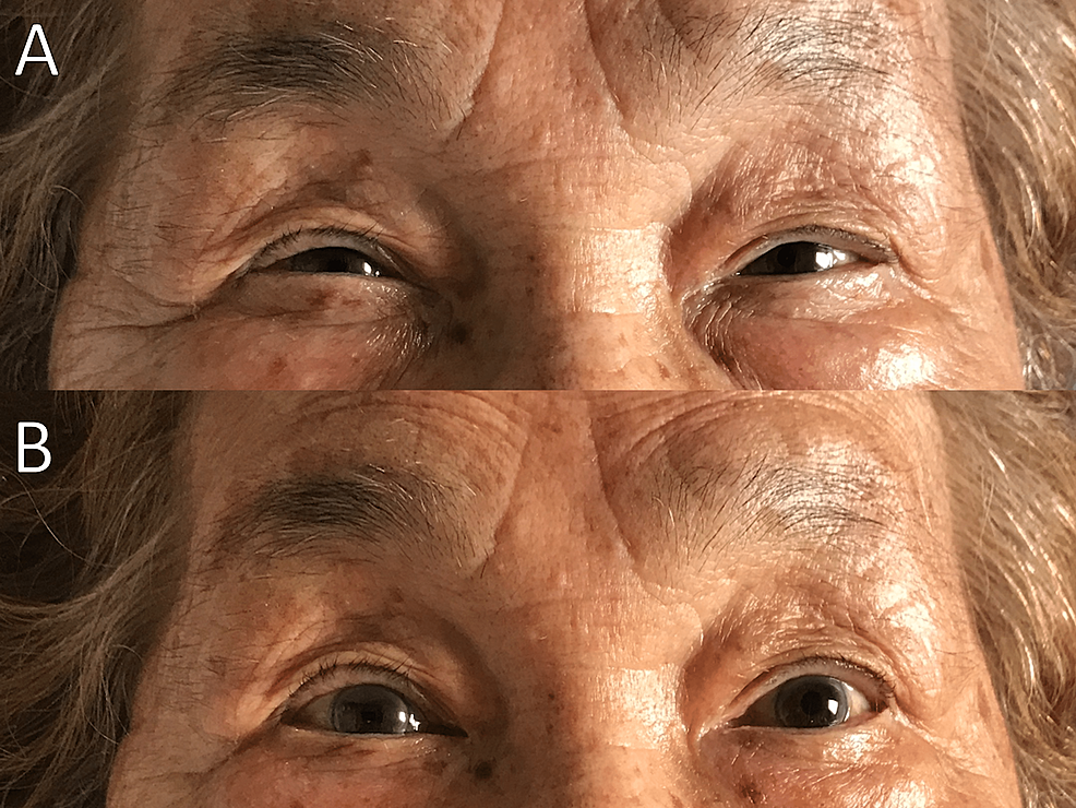 Cureus Seronegative Ocular Myasthenia Gravis In An Older Woman With 