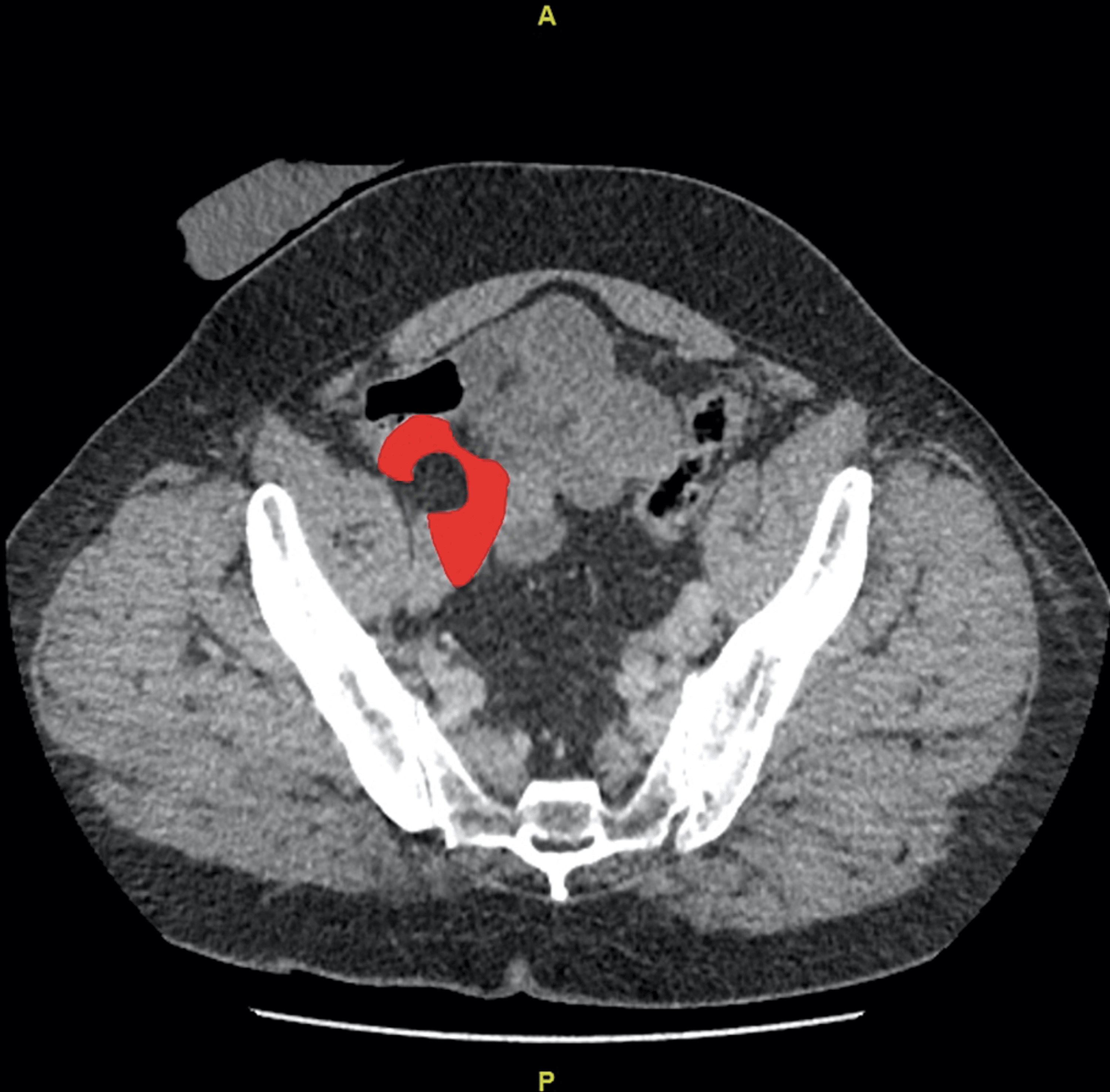 Cureus Ileal Obstruction Secondary To Internal Hernia Under The External Iliac Artery A Case 7130