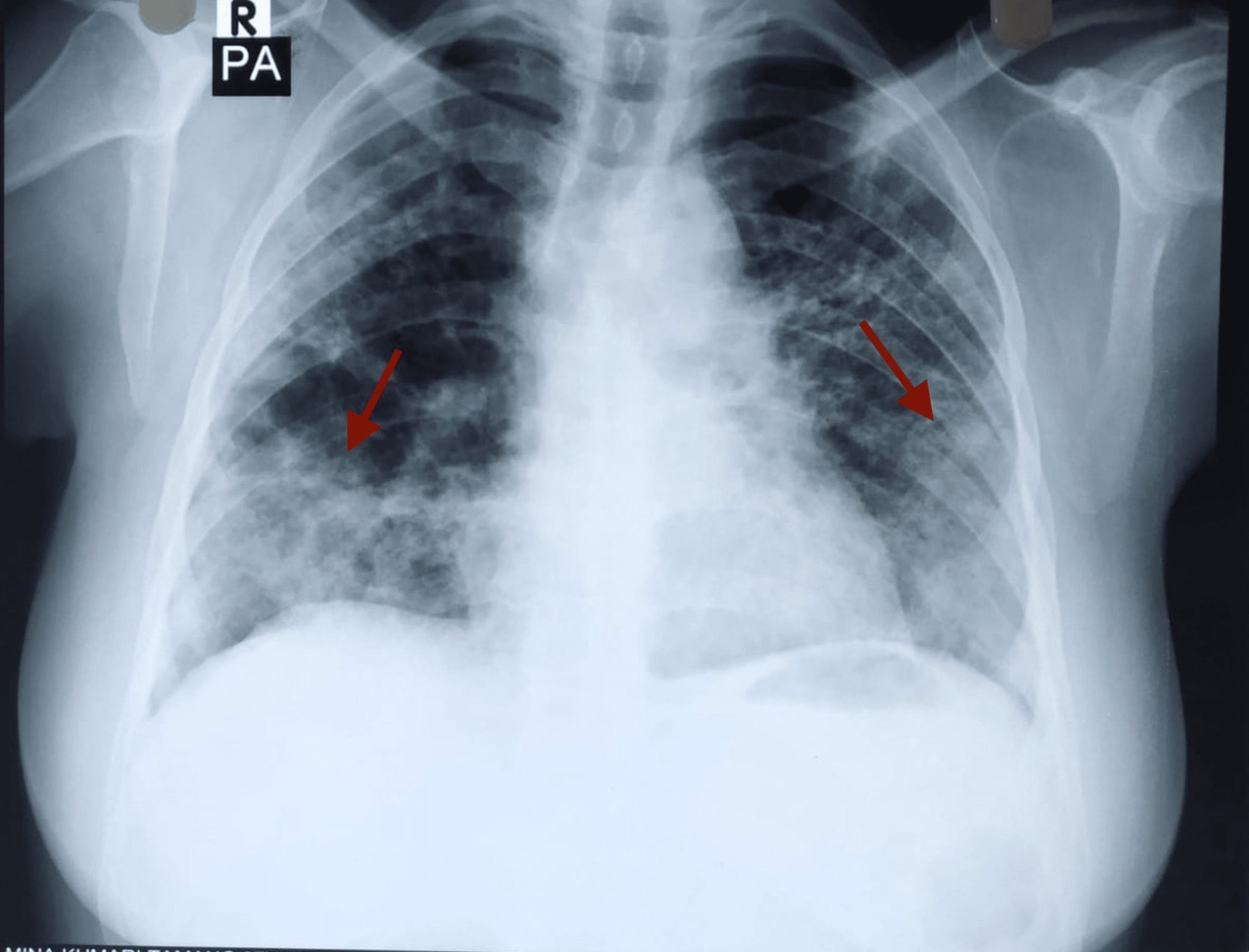 Acute Pancreatitis, Shock, and Multiple Organ Dysfunction Syndrome in