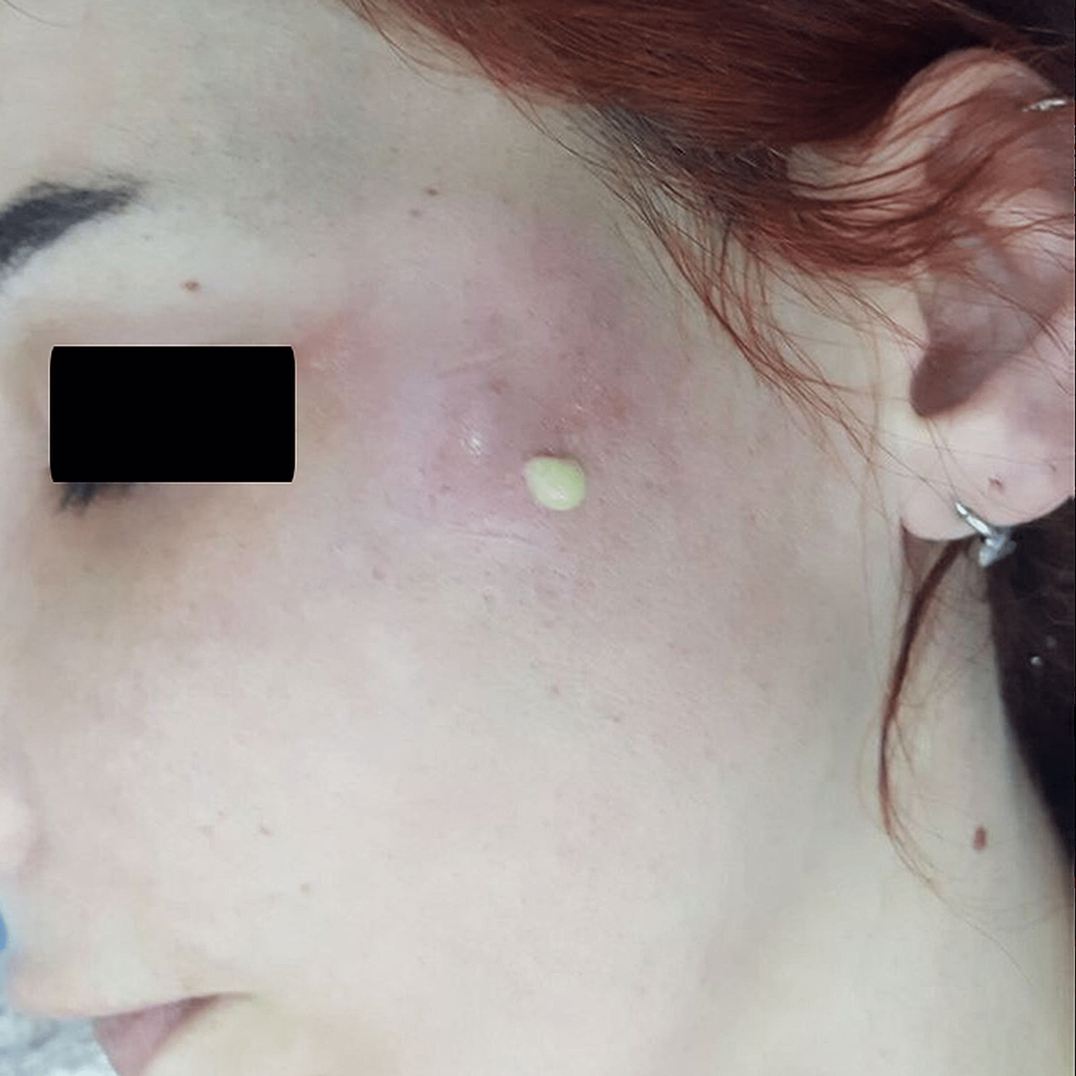 Abscess Formation After Tooth Extraction A LongTerm Complication of