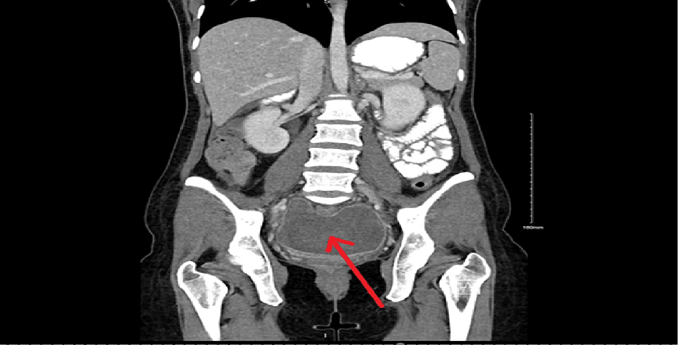 CT-coronal-view-demonstrating-a-pelvic-collection-measuring-11.7×6.7×11.1-cm-(red-arrow)