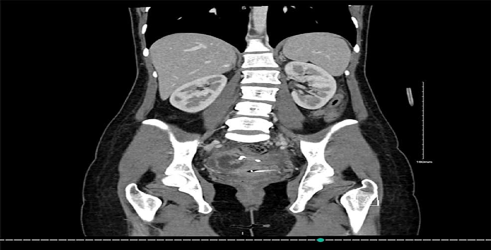 CT-coronal-view-illustrating-a-marked-decrease-in-the-size-of-the-previous-collection