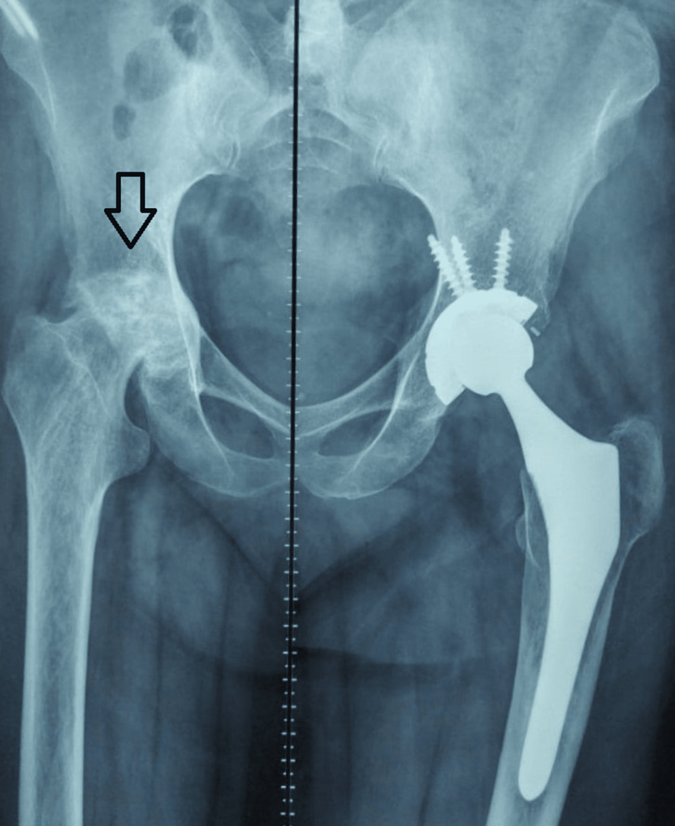 Preoperative-X-ray-showing-right-sided-AVN-(arrow)