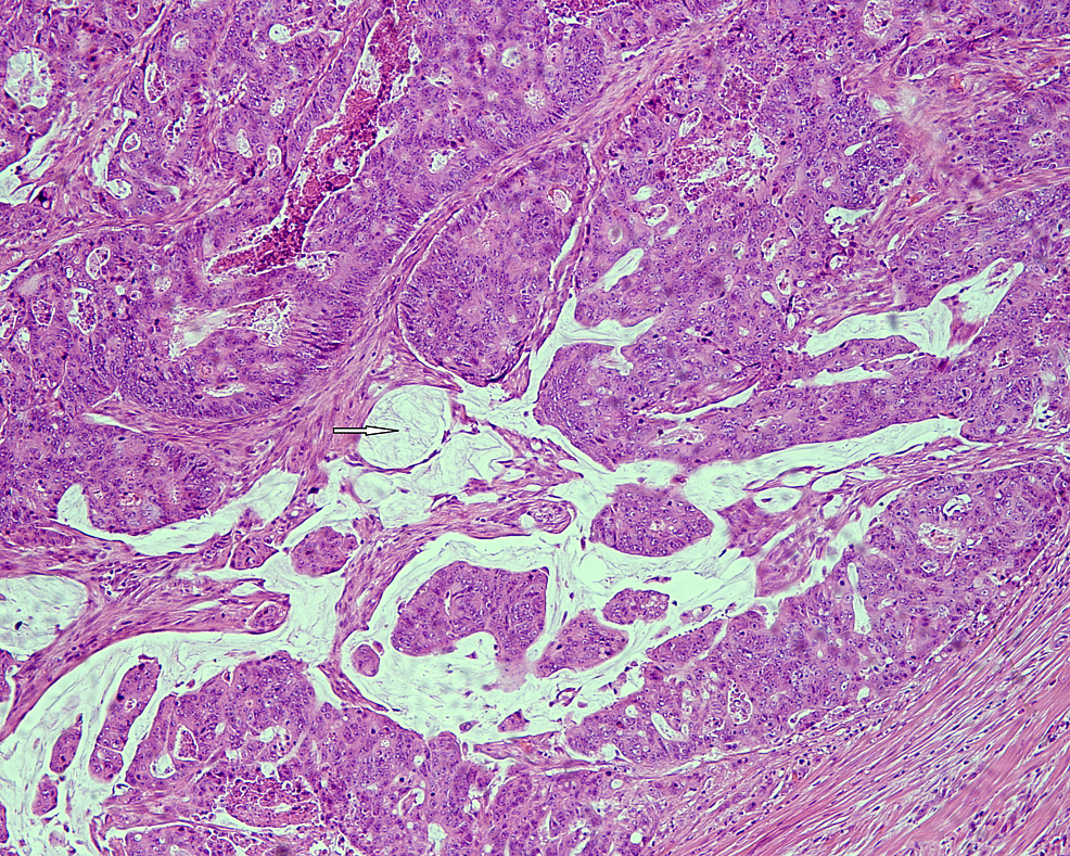 Metastatic Poorly Differentiated Carcinoma Of Unknown Primary Icd 10