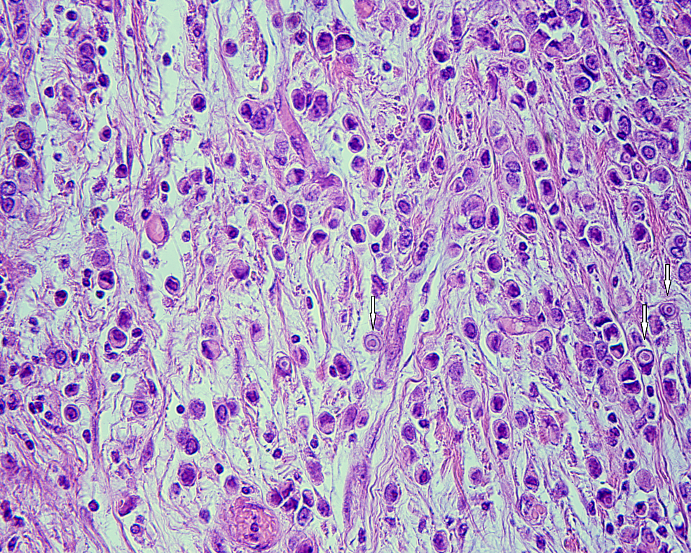 Diffuse-type-carcinoma-cells-display-eccentric-nuclei-and-intracytoplasmic-lumina-(white-arrows)-at-high-magnification-(HE-x-400).