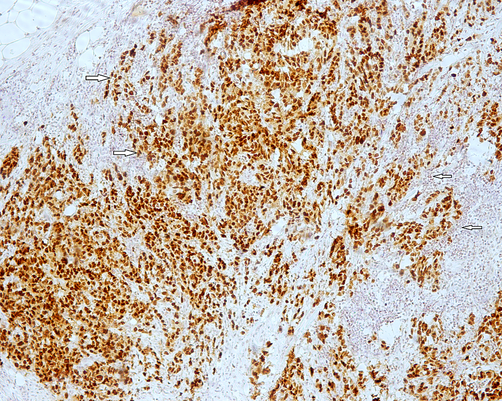CDX-2-is-diffusely-positive-in-colonic-carcinoma-cells-(white-arrows)-(CDX-2-x-100).
