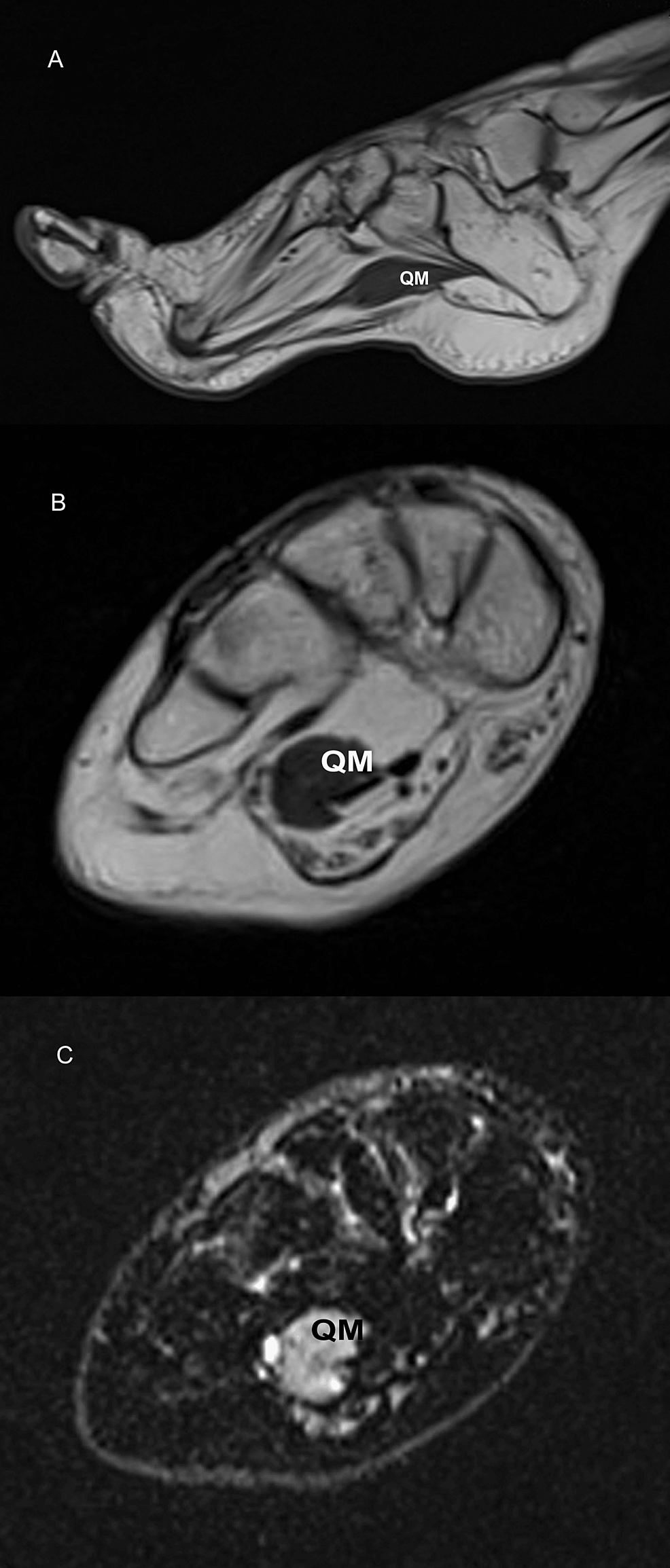 A-46-year-old-female-refugee-with-foot-drop-related-to-skeletal-muscle-channelopathy-(sodium-channel-myotonia).