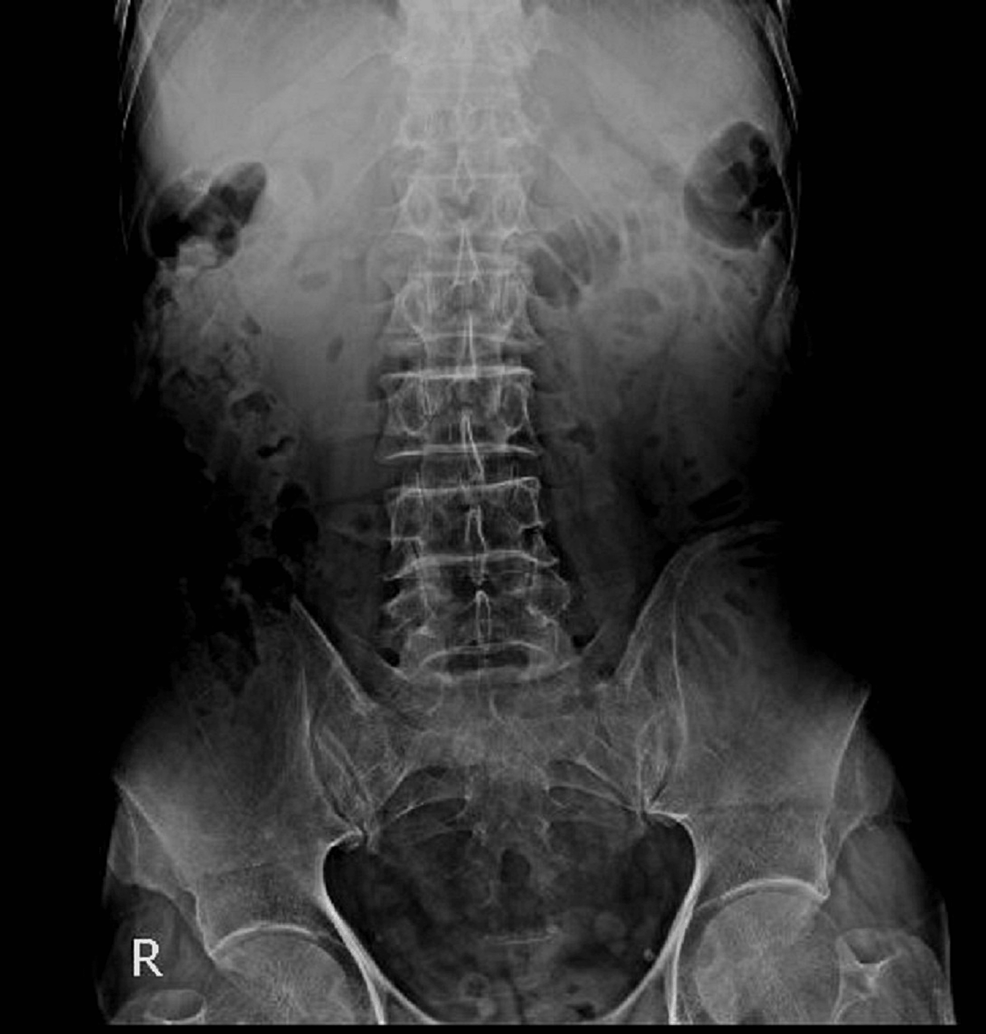 Upright-abdominal-X-ray-showing-mildly-dilated-small-bowel-loops