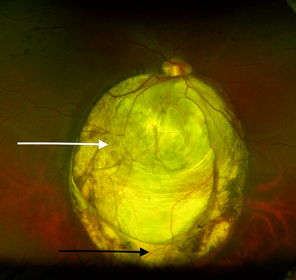 Posterior Coloboma