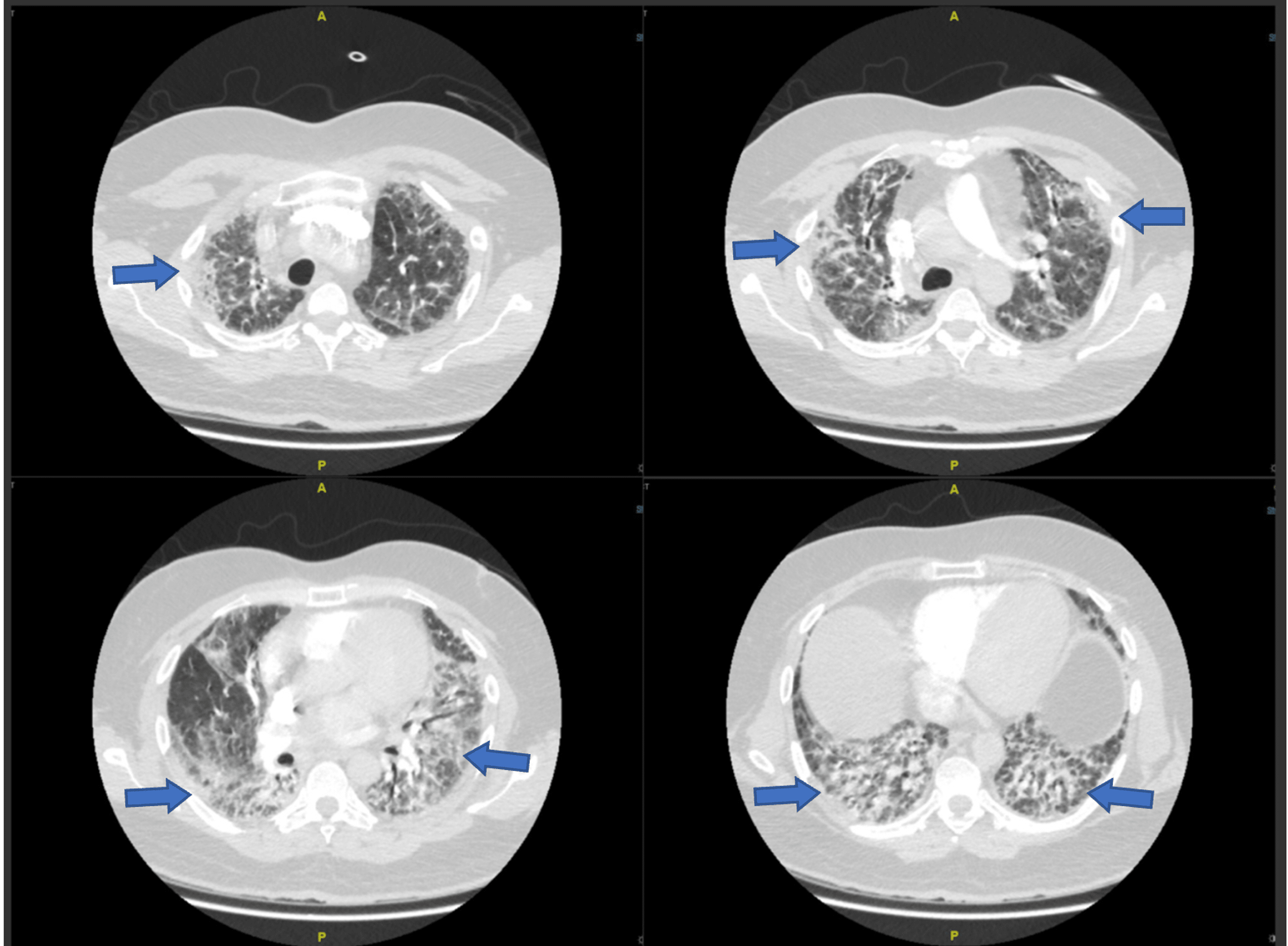 Clinically Amyopathic Dermatomyositis With Rapid Progressive