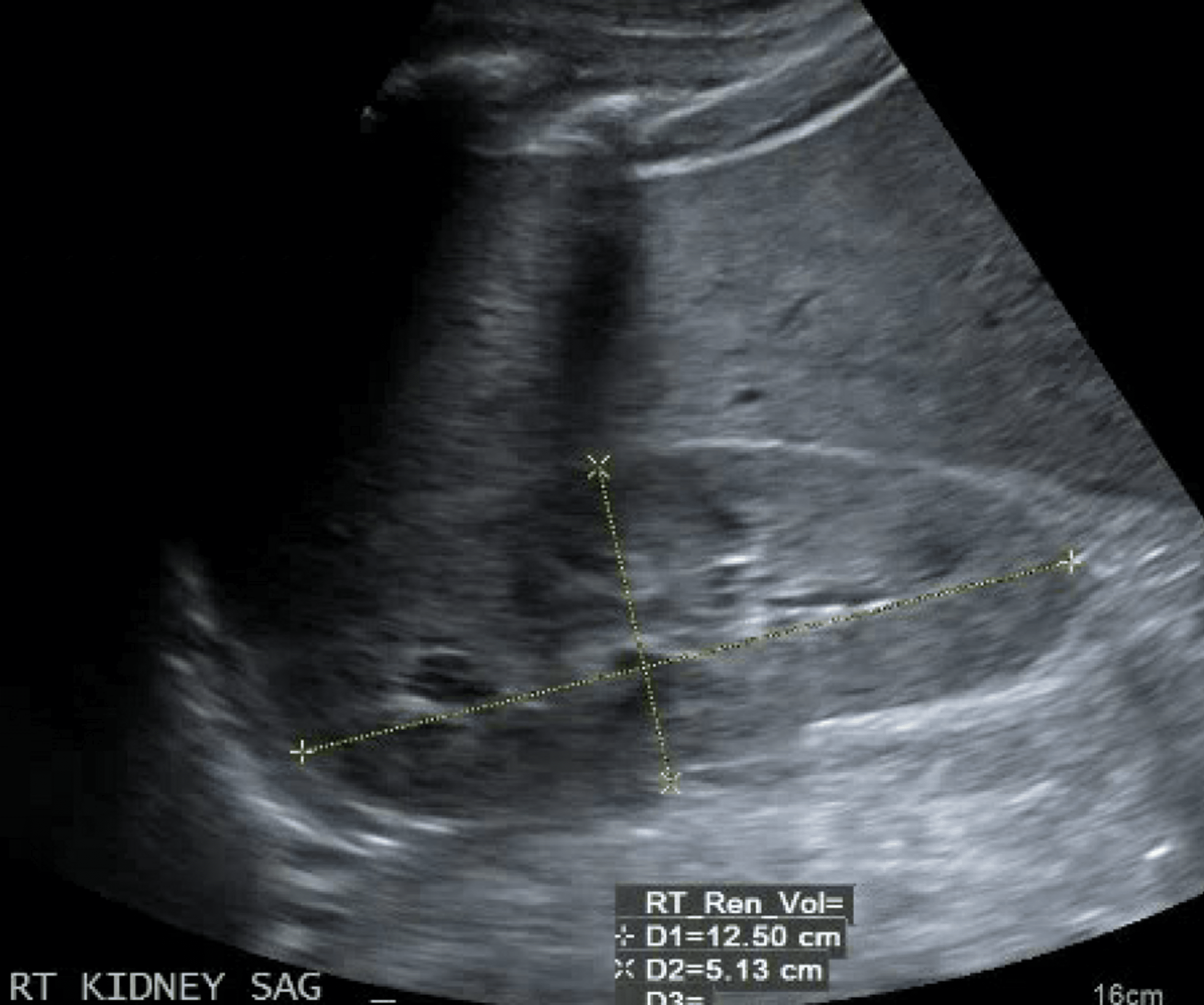 Cureus The Vicious Cycle of Hypothyroidism and Severe Proteinuria A