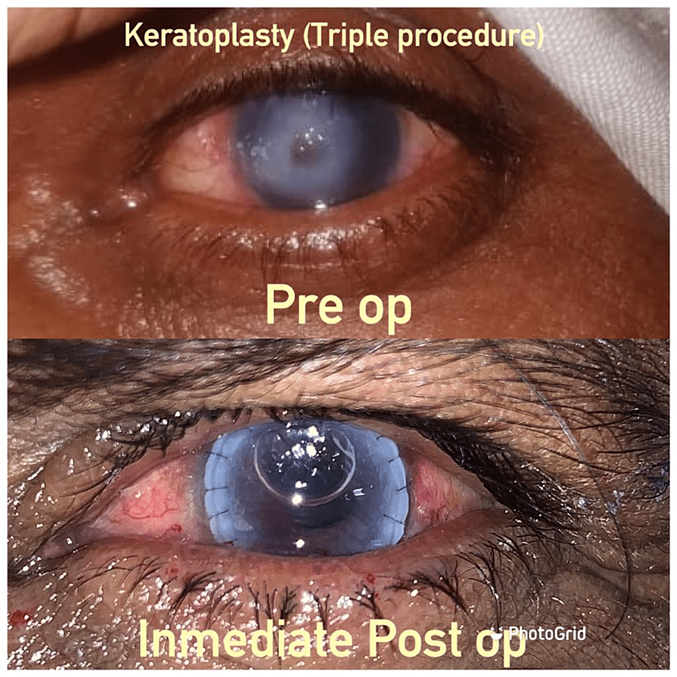 Cureus A Case Report of the Triple Procedure in a Patient