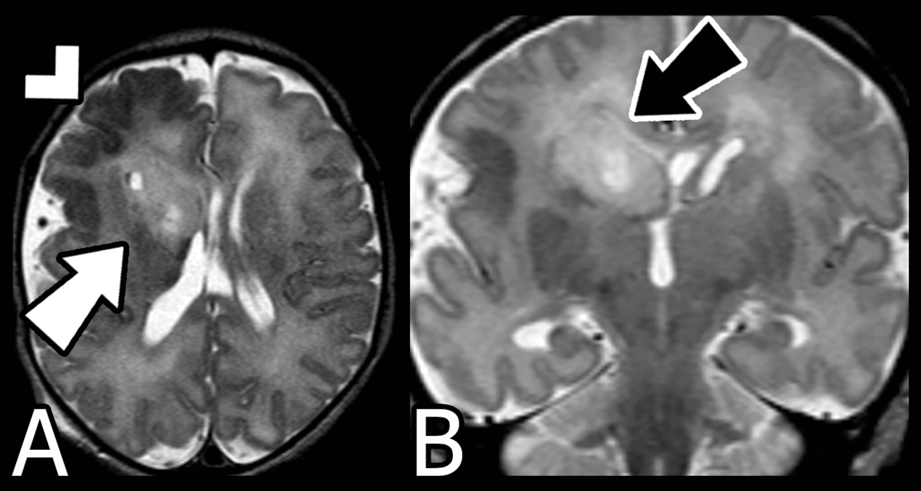 Cureus | Hemimegalencephaly: Evolution From An Atypical Focal Early ...