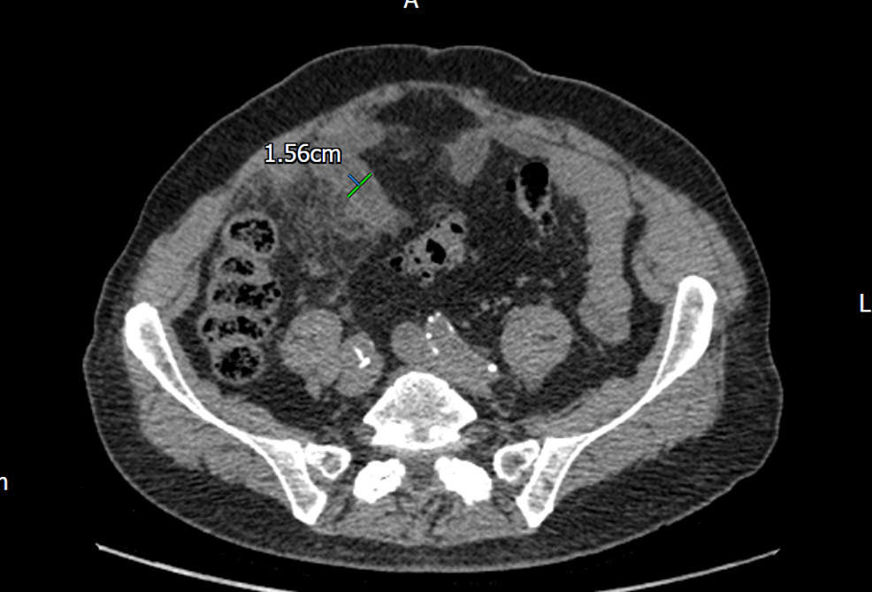 Diverticulitis And Diverticulosis Of The Appendix: A Case Series | Cureus