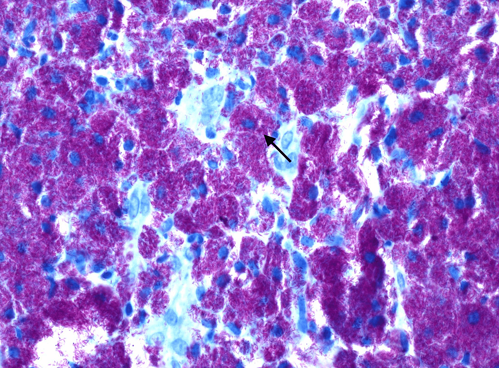 Rod-shaped-bacilli-with-Kinyoun-AFB-stain-(arrow)-shown-densely-packed-within-histiocytes-of-the-colon,-consistent-with-Mycobacterium-avium-complex-(400x-magnification)