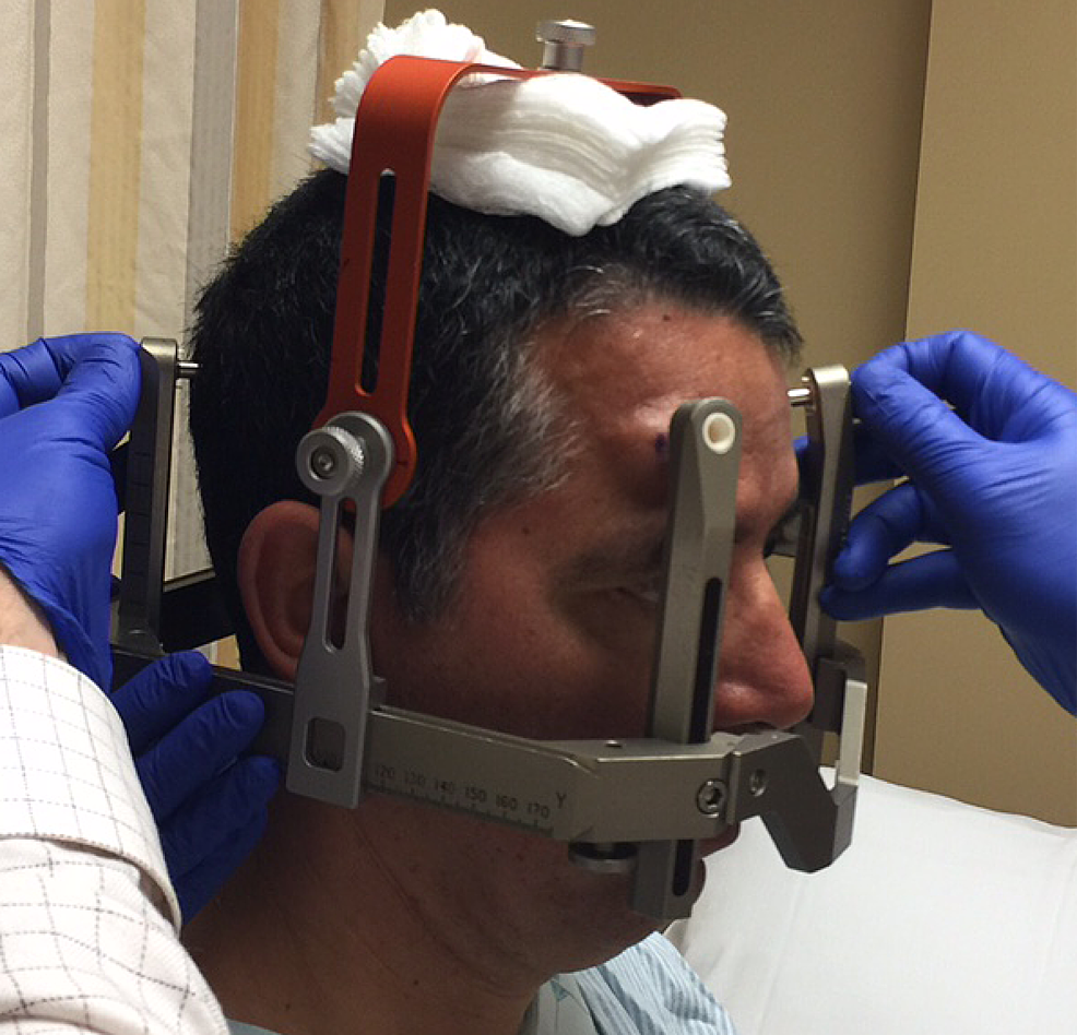 Cureus Techniques for the Application of Stereotactic Head Frames