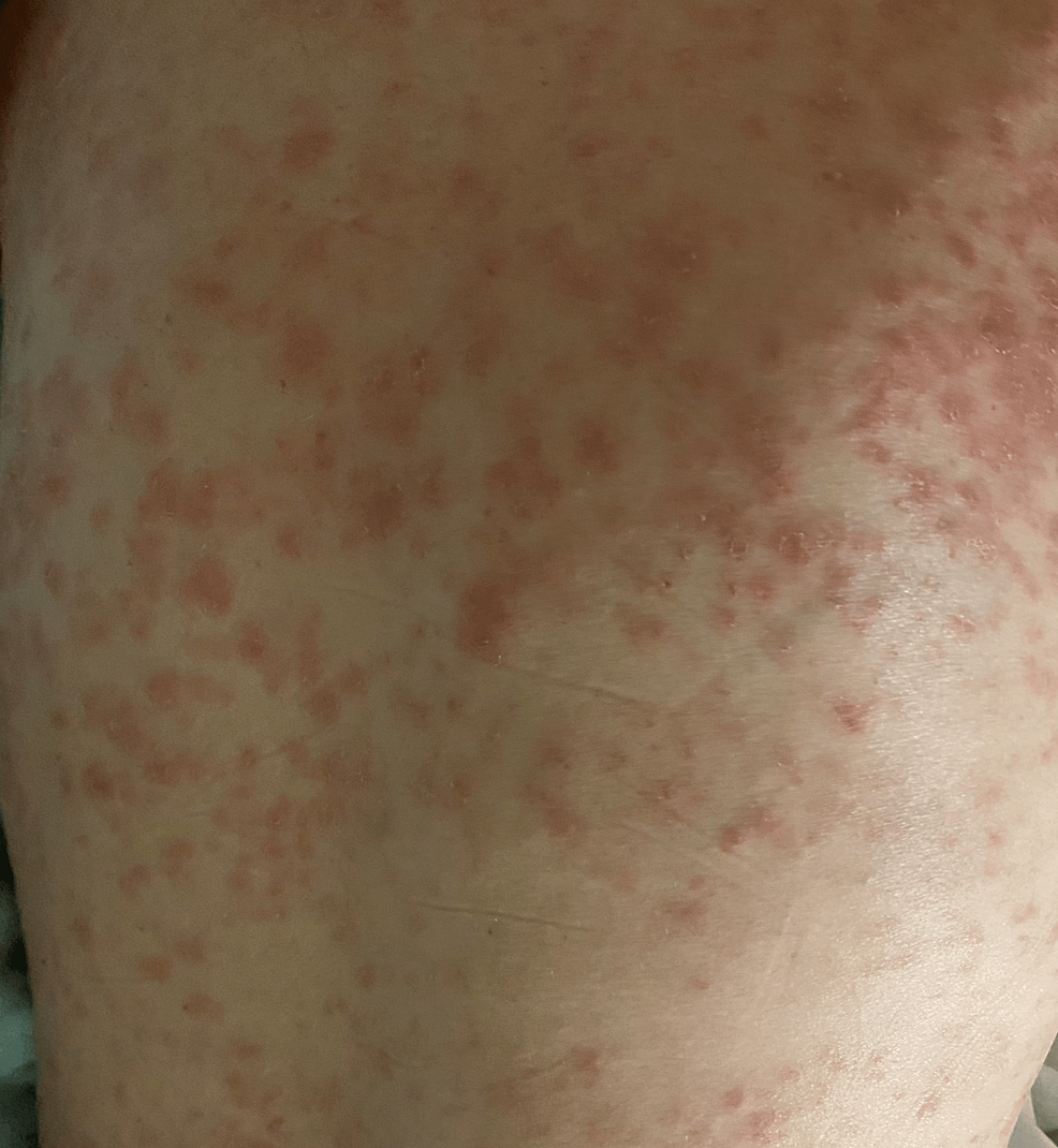 Patient's-physical-exam-findings-of-the-back-showing-a-diffused,-non-confluent-and-erythematous-maculopapular-rash.
