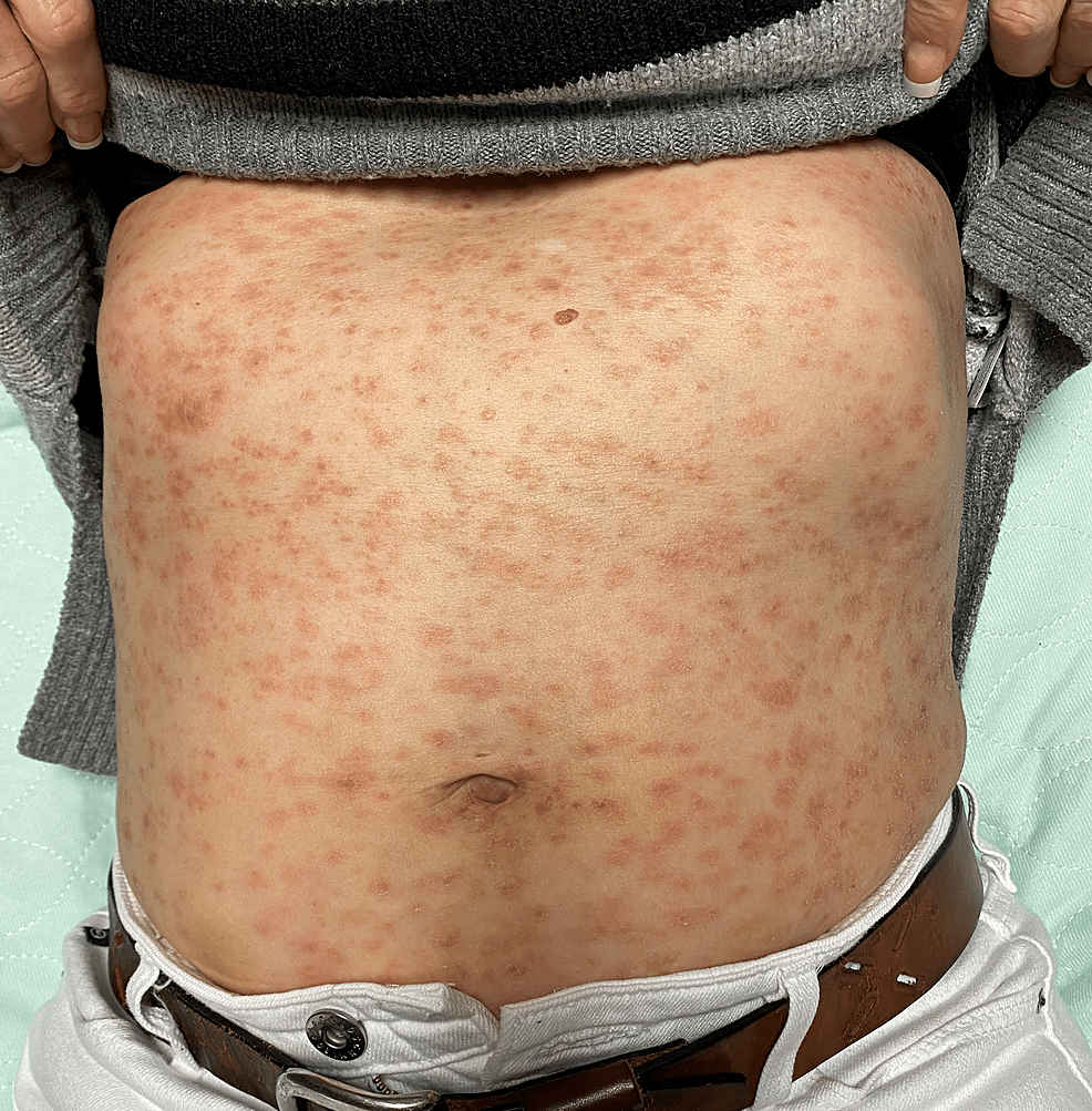 Patient's-physical-exam-findings-of-the-abdomen-showing-a-diffused,-non-confluent-and-erythematous-maculopapular-rash.