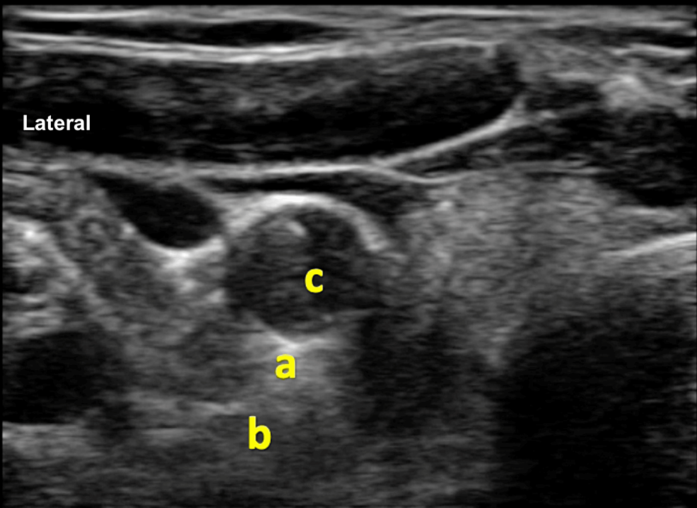 Ultrasonographic-image-of-the-right-side-of-the-neck-depicting-stellate-ganglion