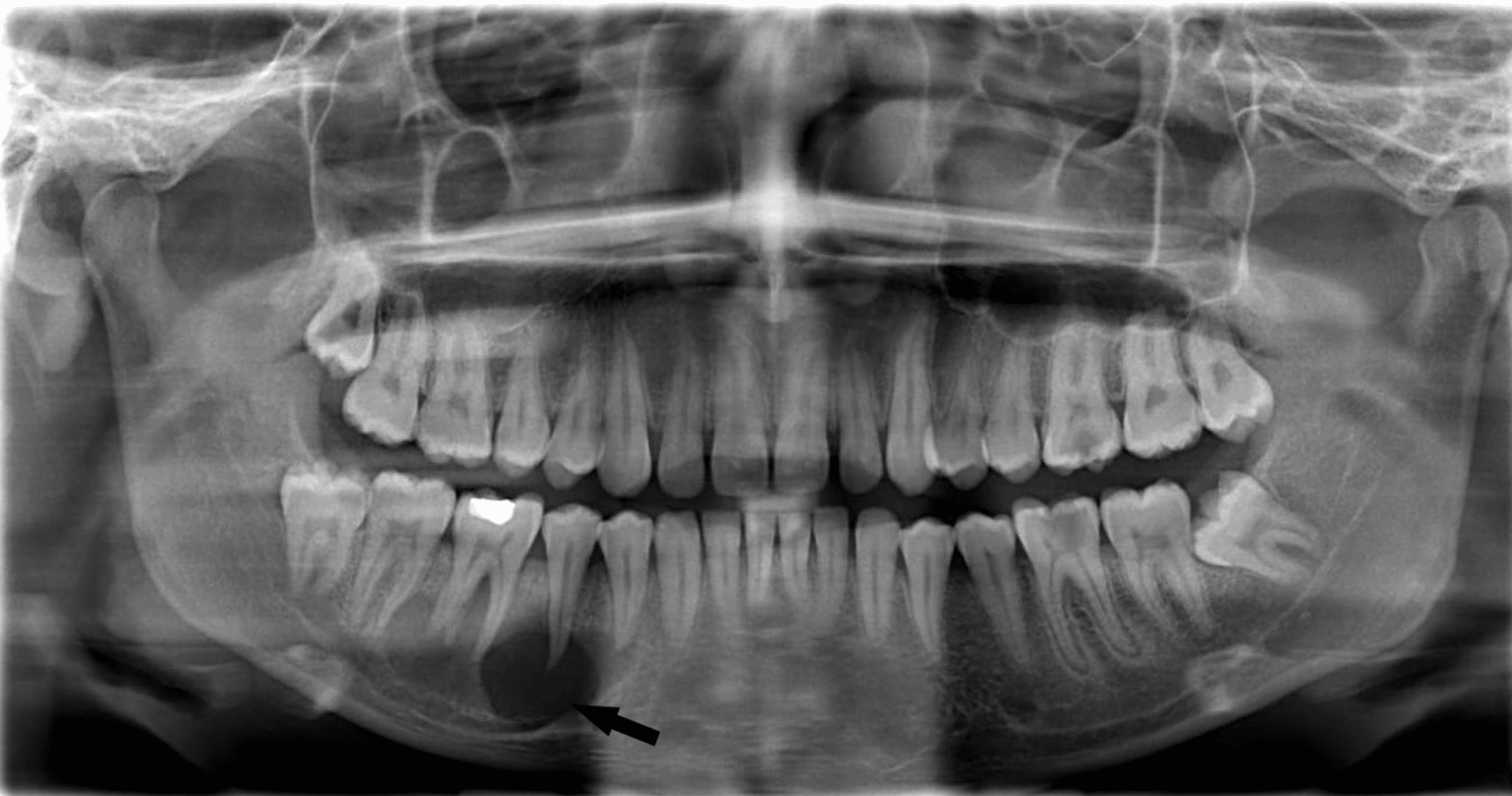 Cureus | Mandibular Actinomycosis Disguised as a Periapical Lesion