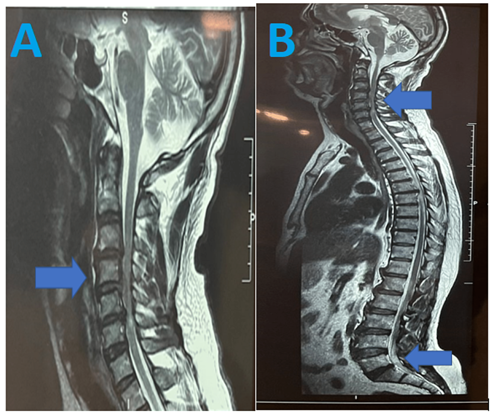 MRI-of-the-cervical-spine