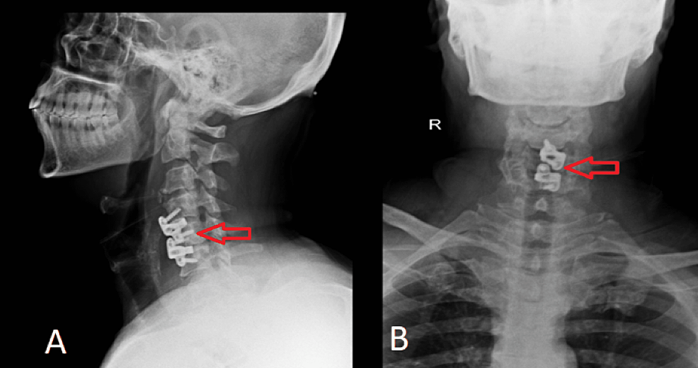 Postoperative-X-ray-of-the-cervical-spine
