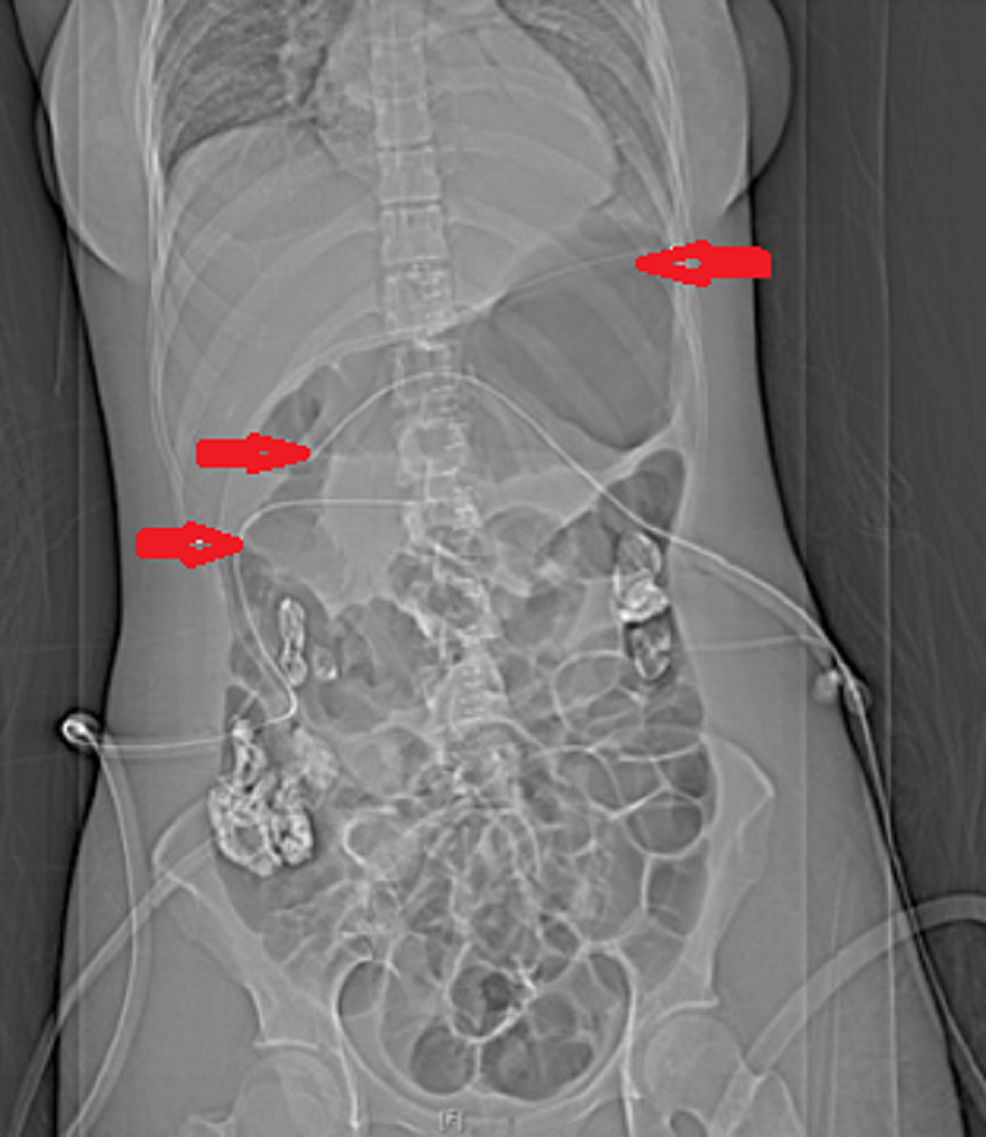 Cureus Therapeutic Serendipity Secondary to Abdominal Drain in