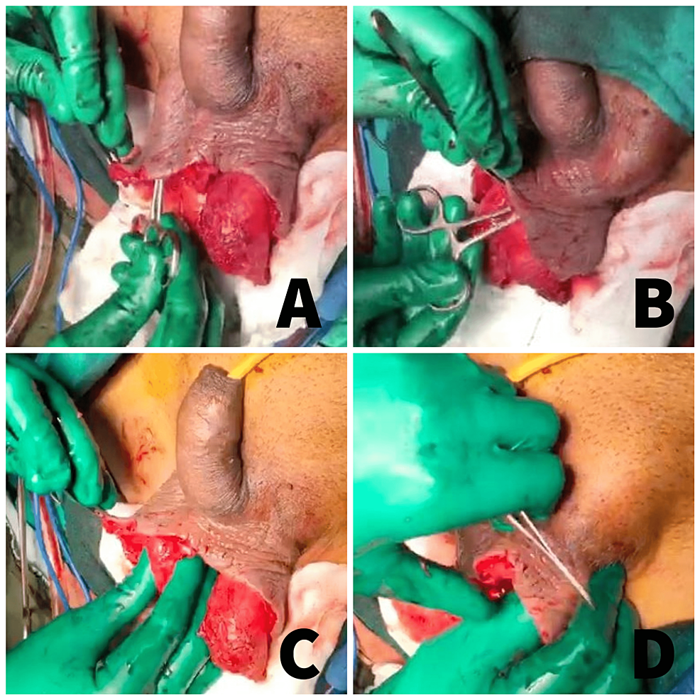 Clinical-images-of-the-technique-of-inguinal-pouch-creation-and-placement-of-the-testes