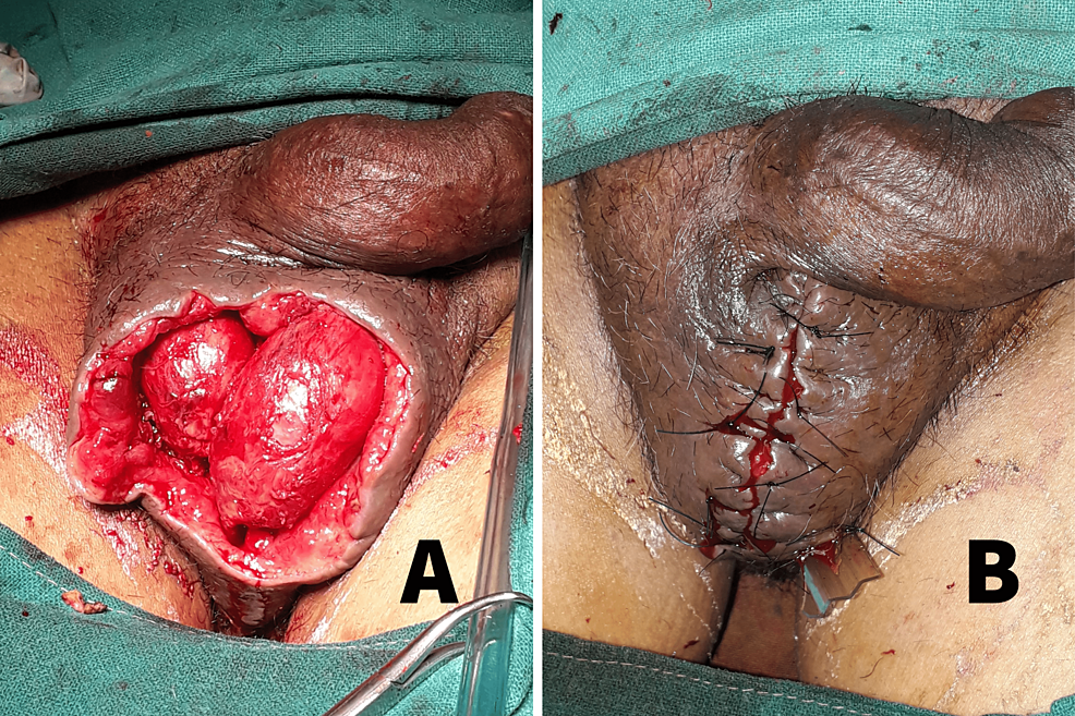 Clinical-images-of-wound-after-re-debridement-and-primary-closure-of-the-scrotum