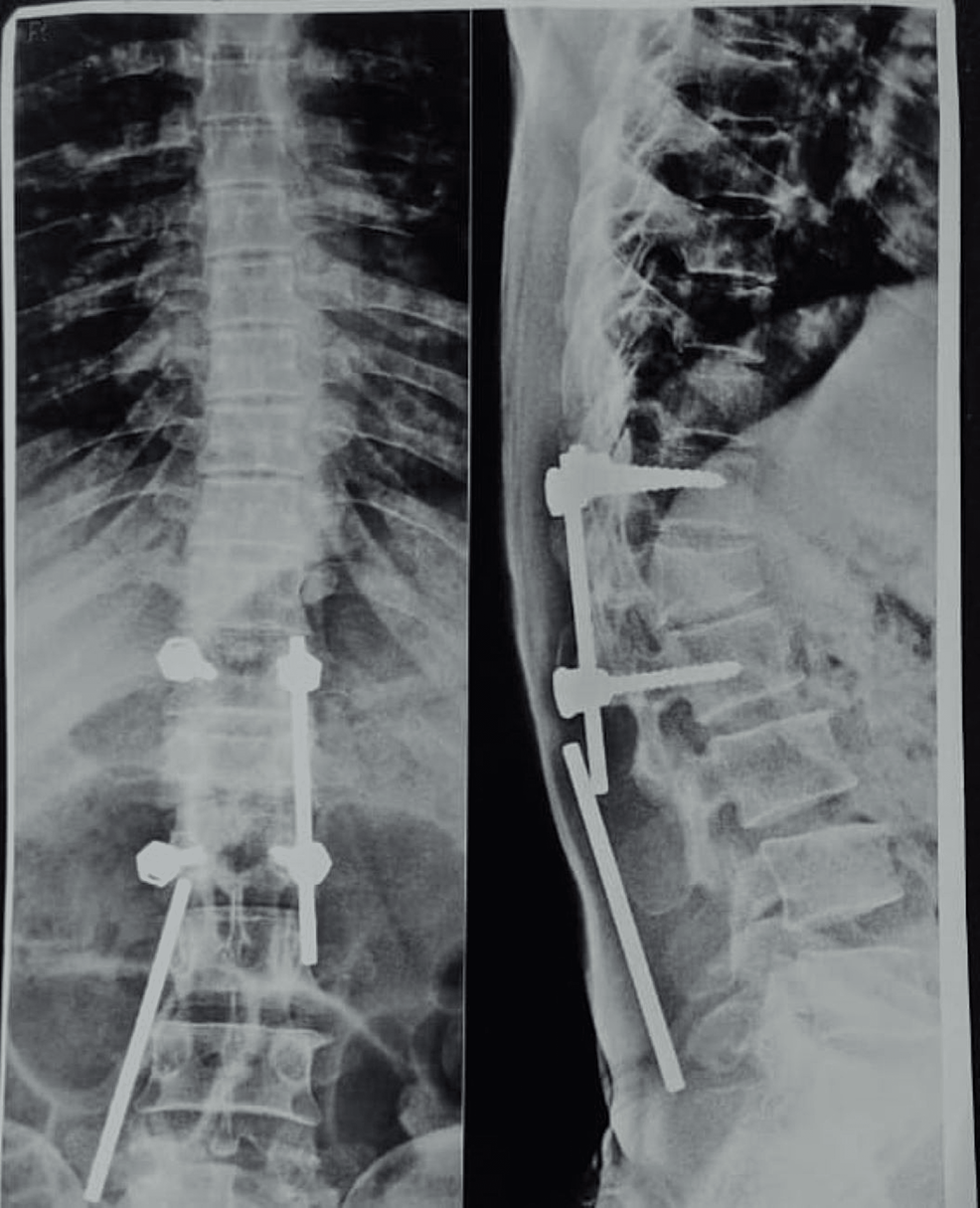 X-ray-of-vertebral-column-of-the-patient-