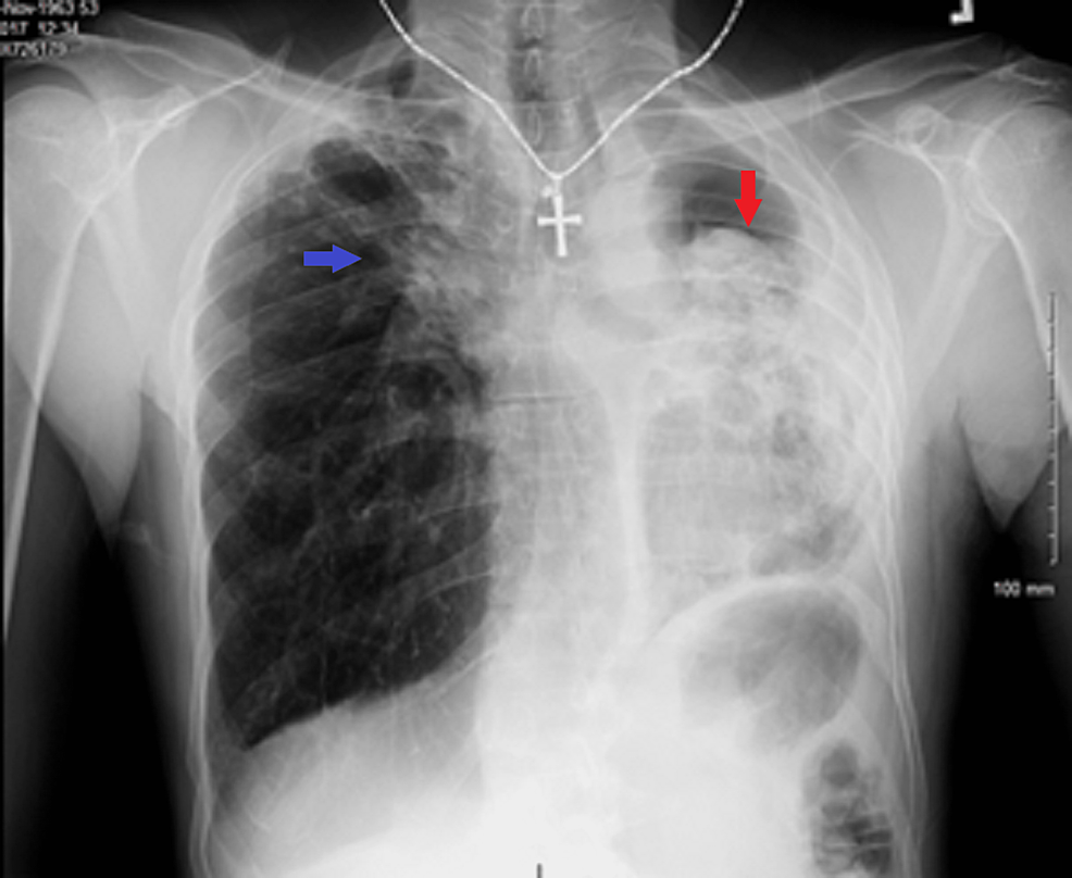 Chest-X-ray-
