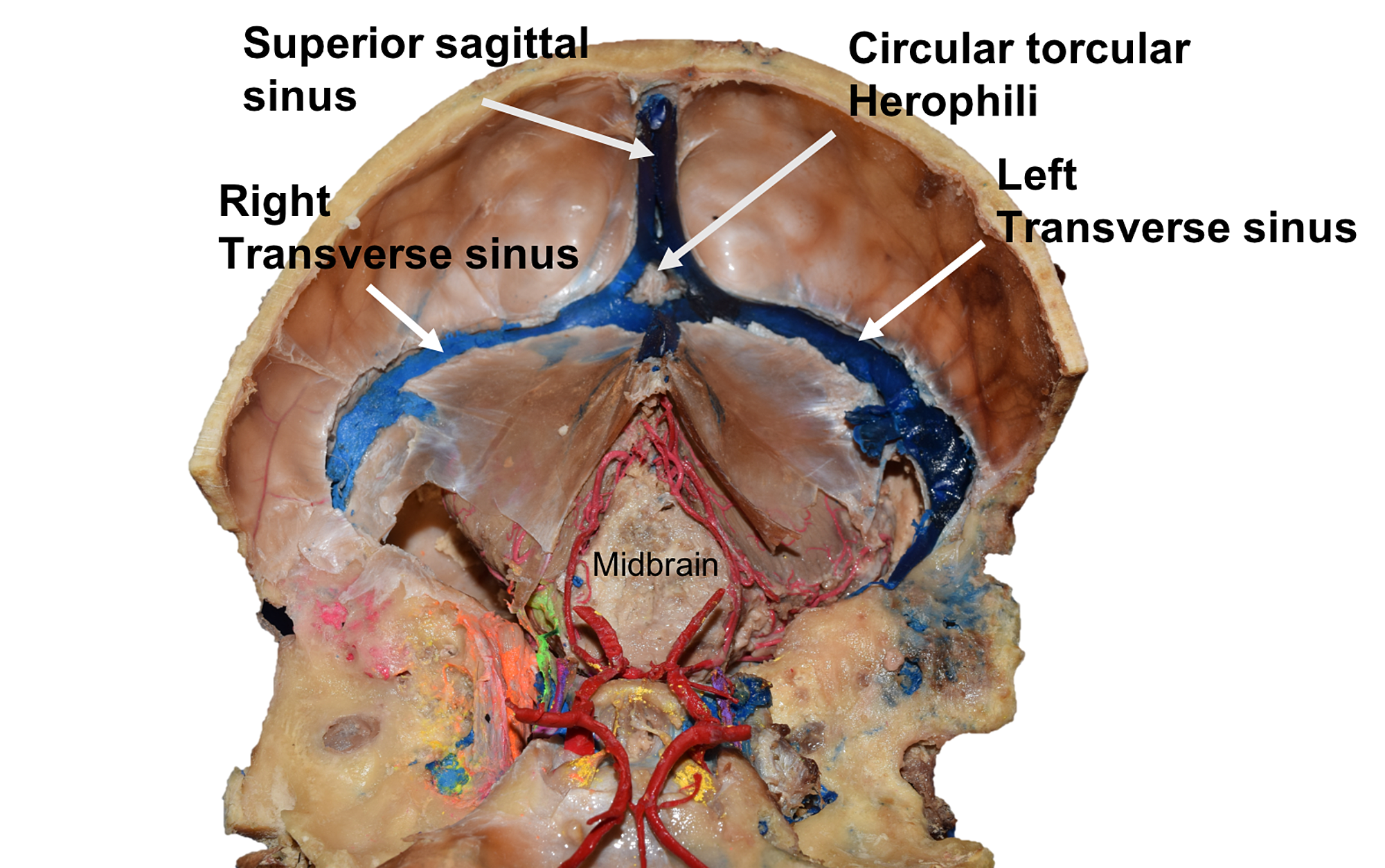 confluence of sinuses skull