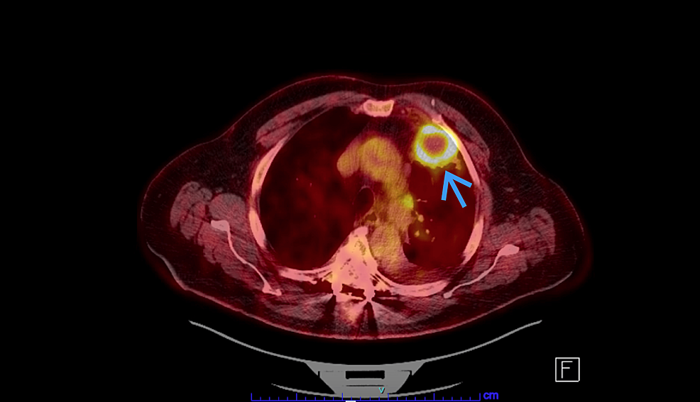 PET-CT-скенер на-гръден кош-с-интензивно-хиперметаболитна-некротична-маса-в-предния-ляв-горен-лоб-(Синя-стрелка)