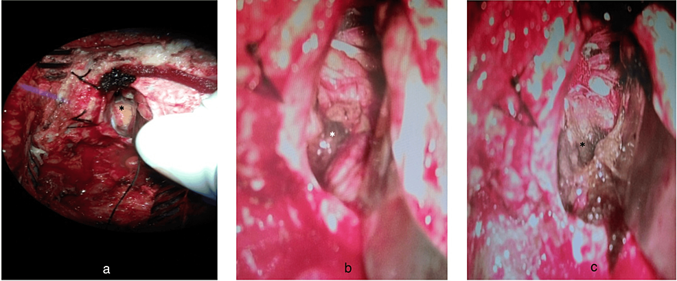 Cerebellopontine-Angle-(CPA)-Lesion-Intra-Operative-Quirurgico-Imágenes-
